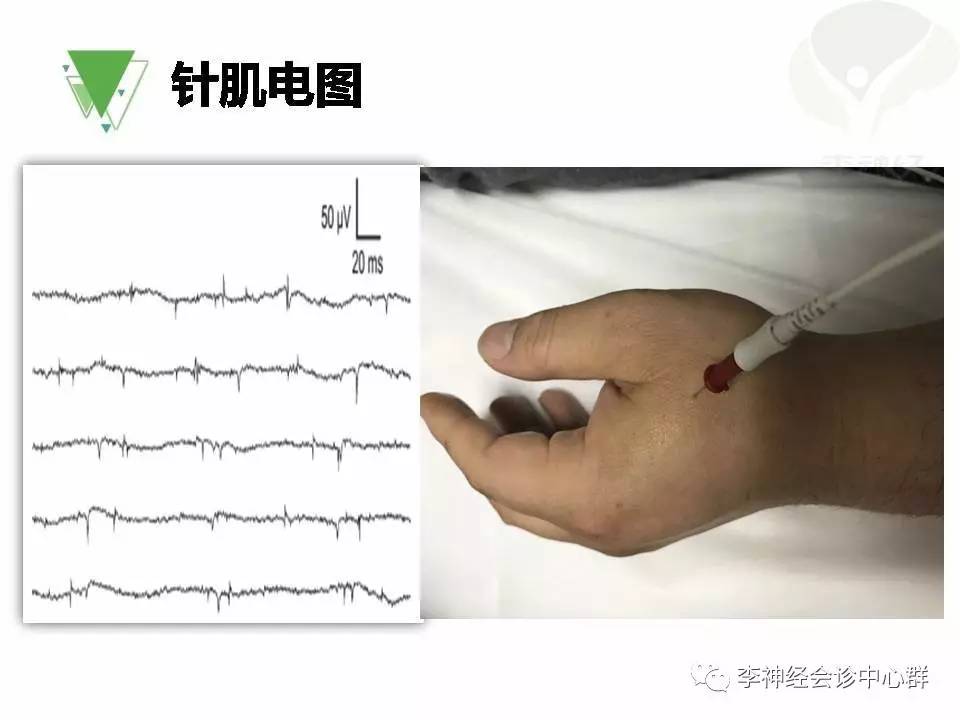 ppt漸凍人運動神經元病als肌電圖與臨床馮淑豔