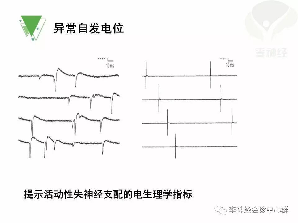 ppt渐冻人运动神经元病als肌电图与临床冯淑艳