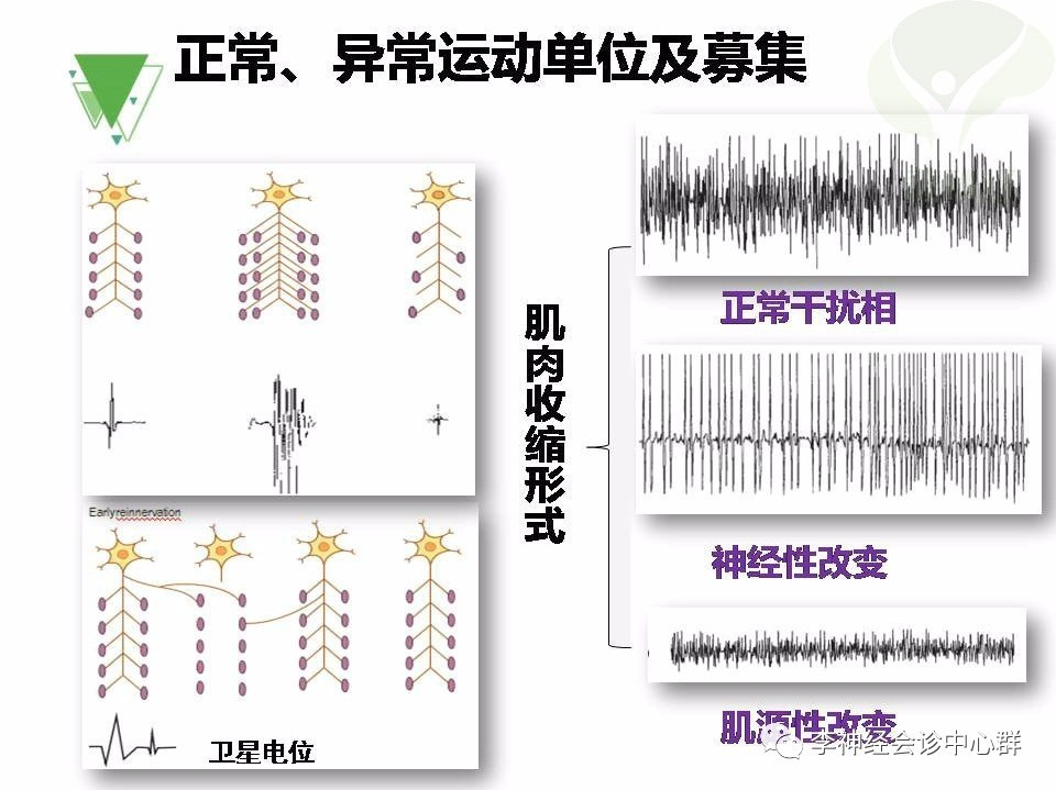 渐冻症肌电图表现图片