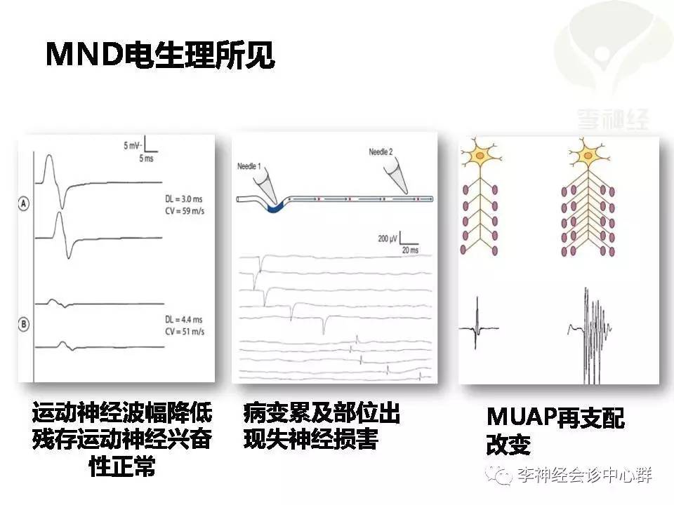 ppt漸凍人運動神經元病als肌電圖與臨床馮淑豔