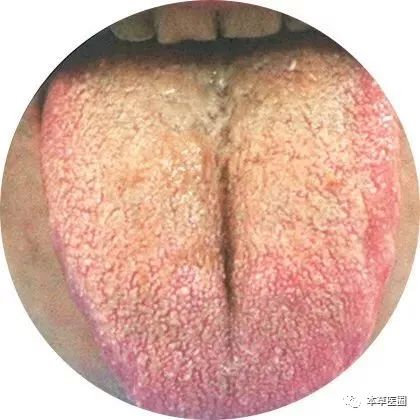 高清舌诊图谱(九)——湿热体质典型舌象
