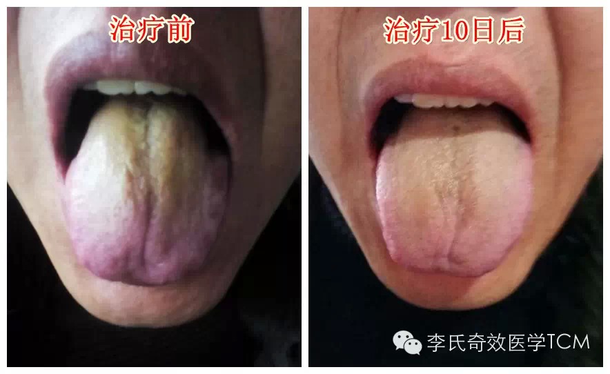 李氏全息舌诊与用药四