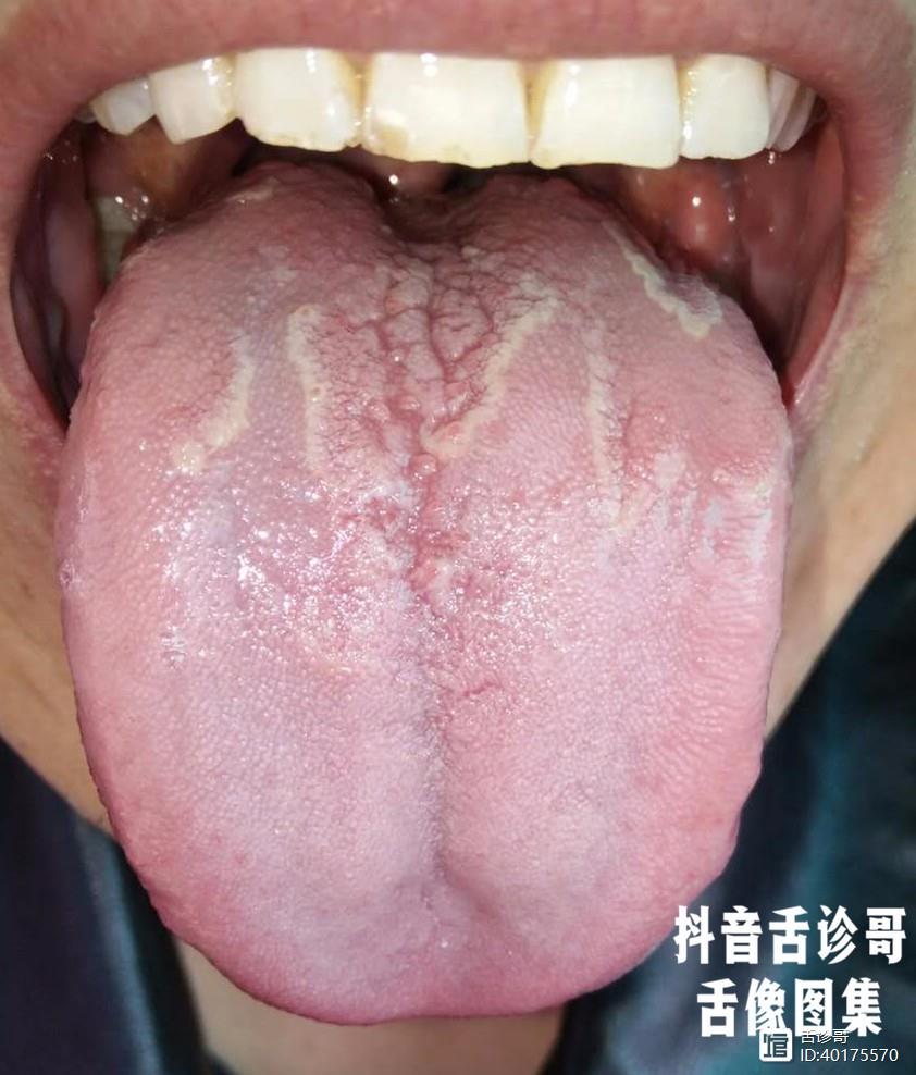 原舌诊哥舌诊知健康教你学会看舌象系列五十七