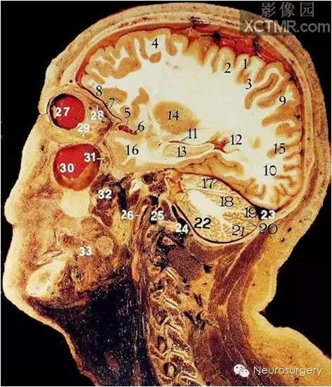 經典顱腦斷層解剖圖矢狀位