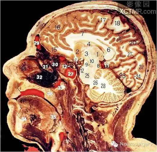 经典颅脑断层解剖图矢状位
