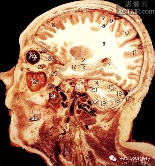 經典顱腦斷層解剖圖矢狀位