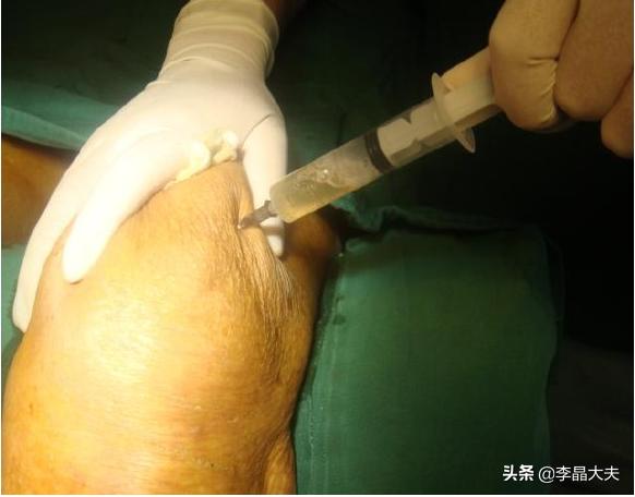 膑韧带外侧1cm处(外侧膝眼,可看到一小凹陷)为穿刺点,针头与胫骨平台