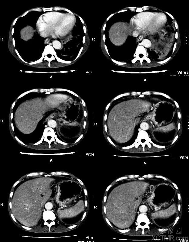 门静脉海绵样变性