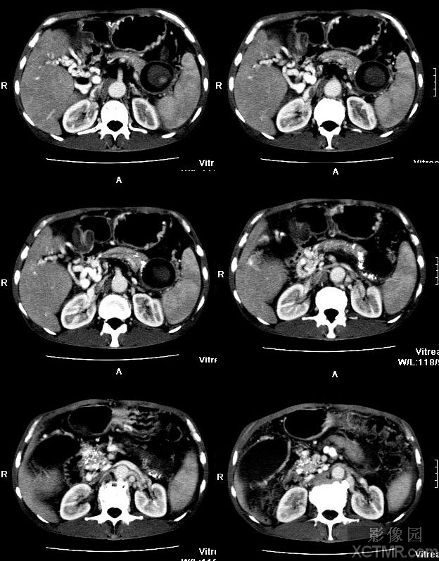 门静脉海绵样变性
