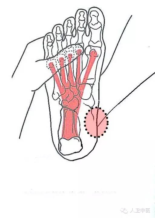 四十三,跟骨骨刺压痛点此症为中,老年及肥胖者常见的患疾,病者足跟