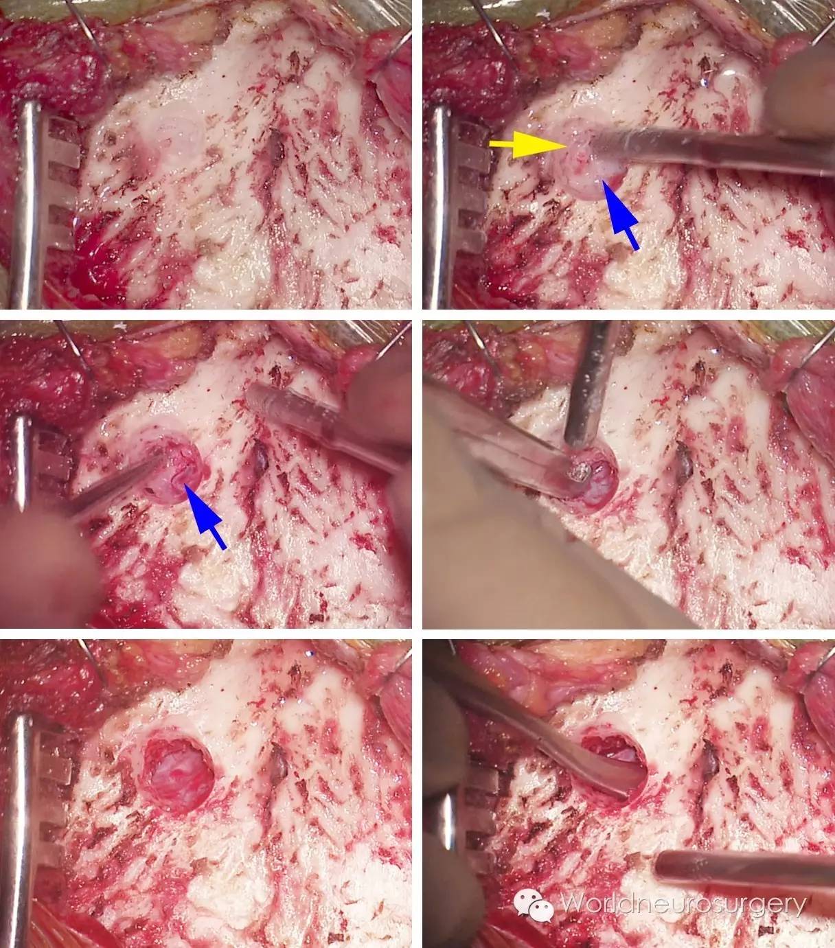 基础开颅技巧之钻孔与骨瓣形成