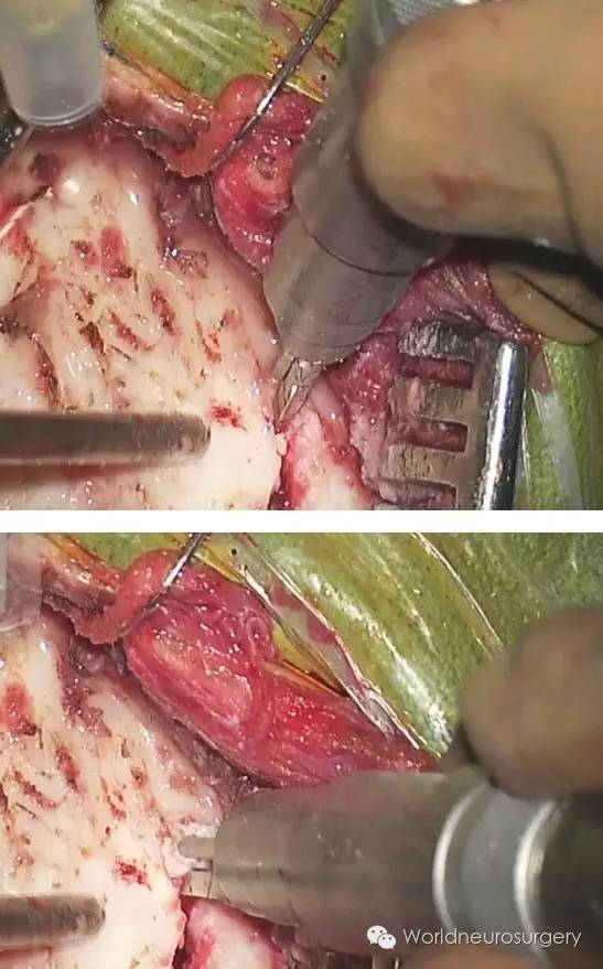 基础开颅技巧之钻孔与骨瓣形成