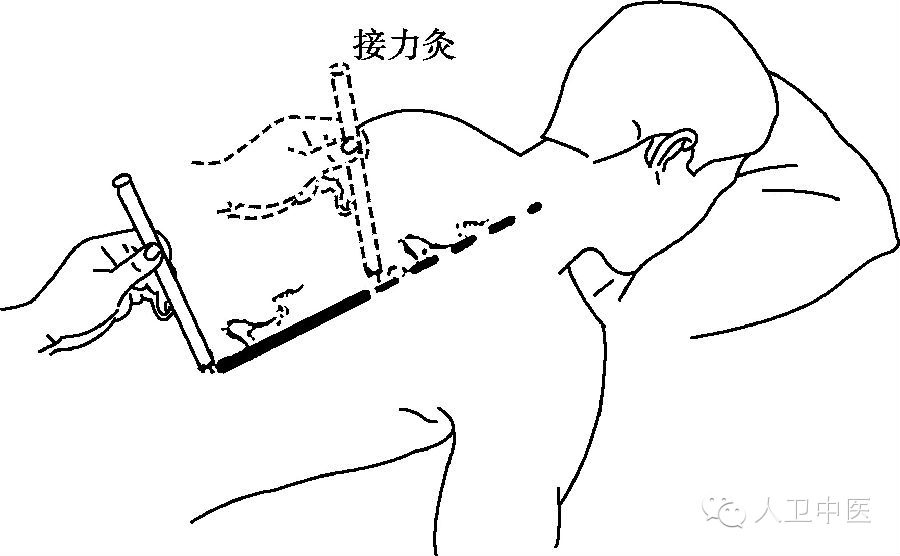 操作手法包括回旋灸,雀啄灸,循经往返灸,温和灸.