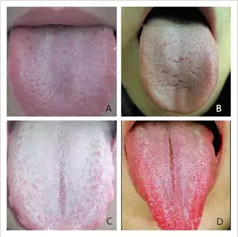 手把手教你學舌診 四種常見舌象用藥一看就會!