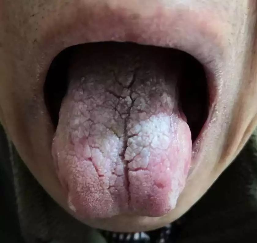 舌头脱皮图片