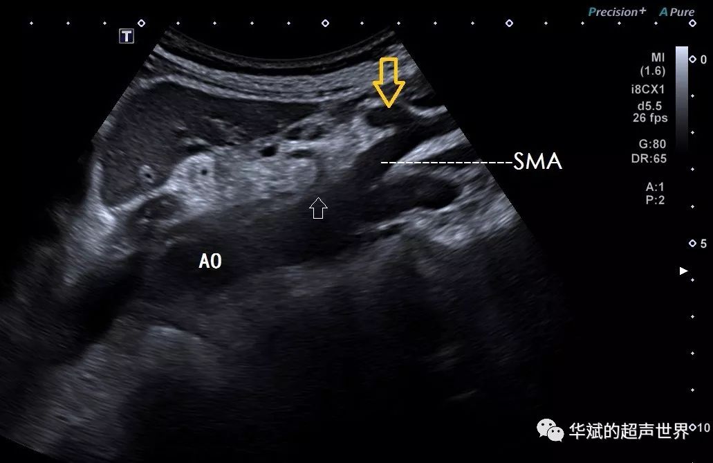 典型图片腹腔动脉压迫综合征中弓韧带综合征