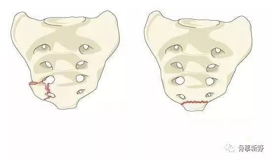 骶骨骨折的解剖概要及分型