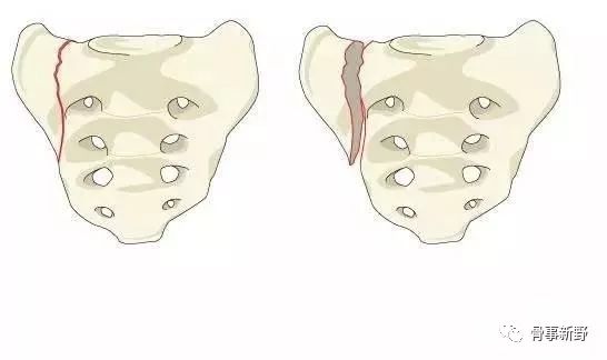骶骨骨折的解剖概要及分型