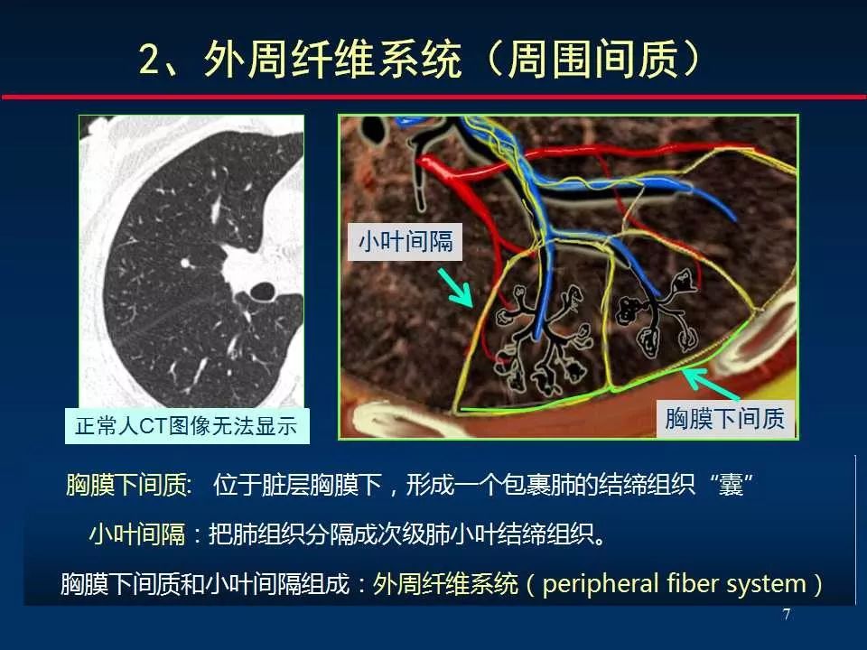 02肺間質改變的基本ct表現1,胸膜下線 subpleural lines2,支氣管血管