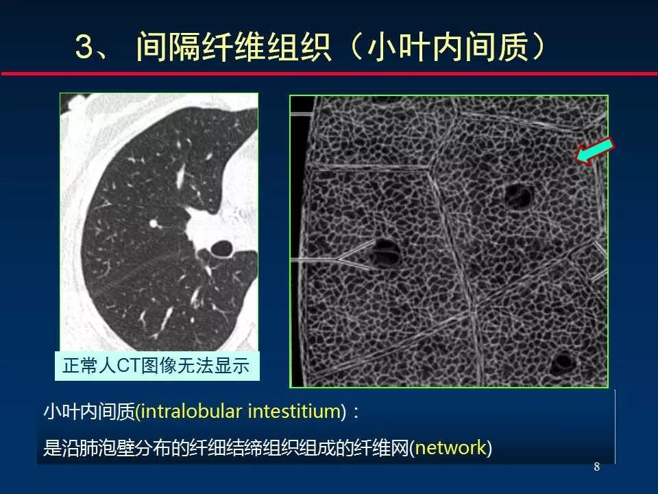 正确判读肺间质改变的基本ct表现 好网角收藏夹