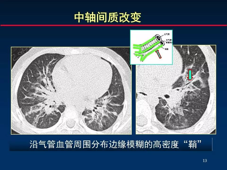 正確判讀肺間質改變的基本ct表現