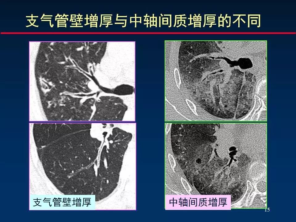 正确判读肺间质改变的基本ct表现