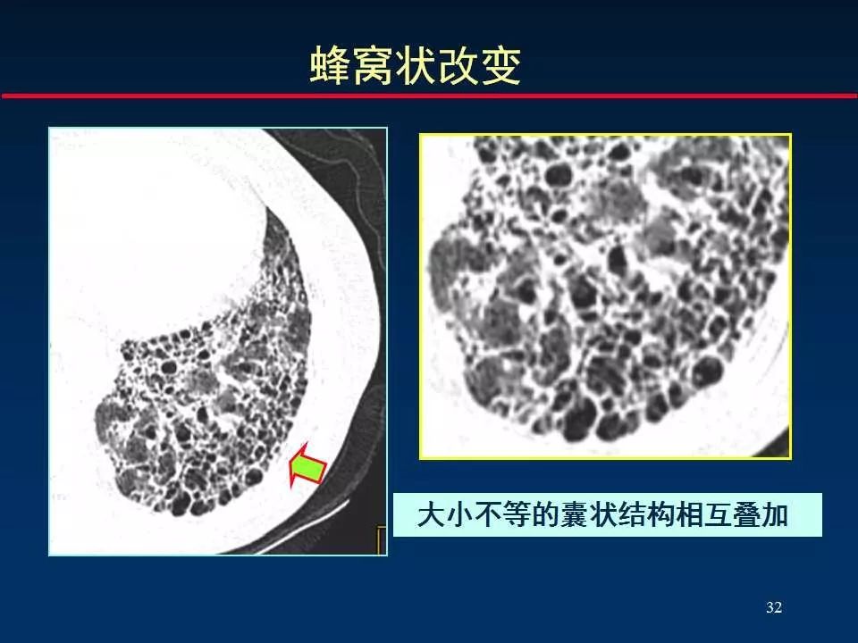 正确判读肺间质改变的基本ct表现