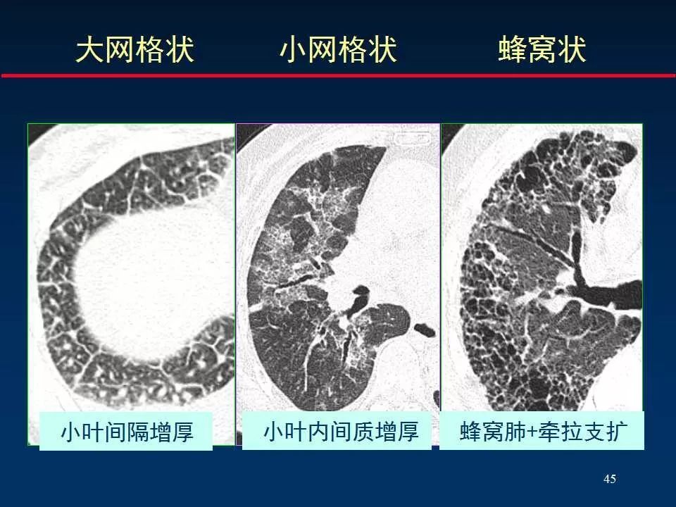 正確判讀肺間質改變的基本ct表現