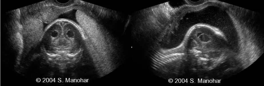 胎儿颅骨形状异常之柠檬头和草莓头