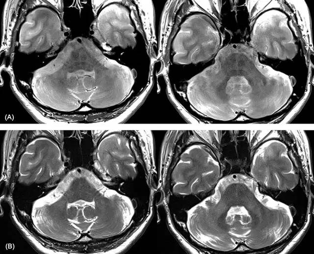 因此,临床上怀疑 msa 而普通 mri 正常的患者,必要时可进一步行 pdwi