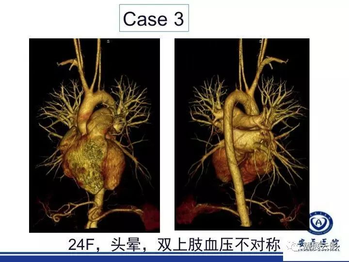 頭臂血管-左側椎動脈狹窄 左鎖骨下動脈鼠尾狀狹窄 肺動脈狹窄