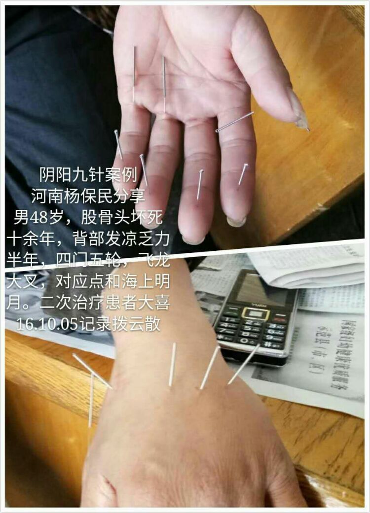 多种针法收集图解供爱好针灸的学友参考 :收集制作 者:尤爱华~中医