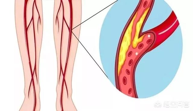外周动脉硬化会导致外周血管变窄甚至堵塞,得四肢血流减少,引起肢体