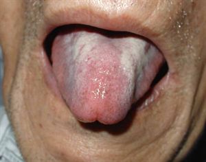 肝硬化的舌象图图片