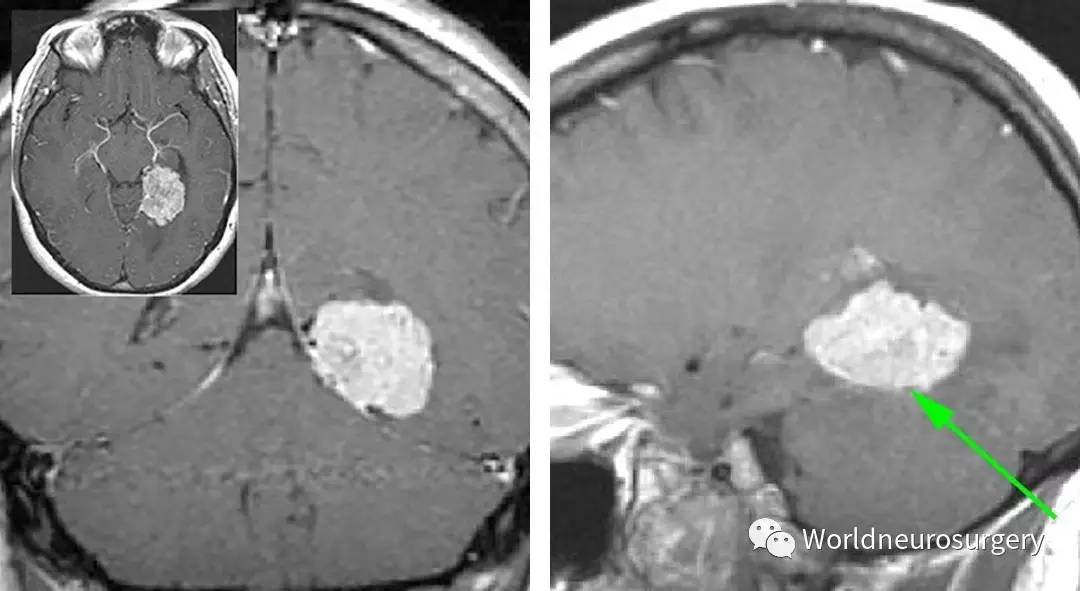 小腦幕腦膜瘤--the neurosurgical atlas系列