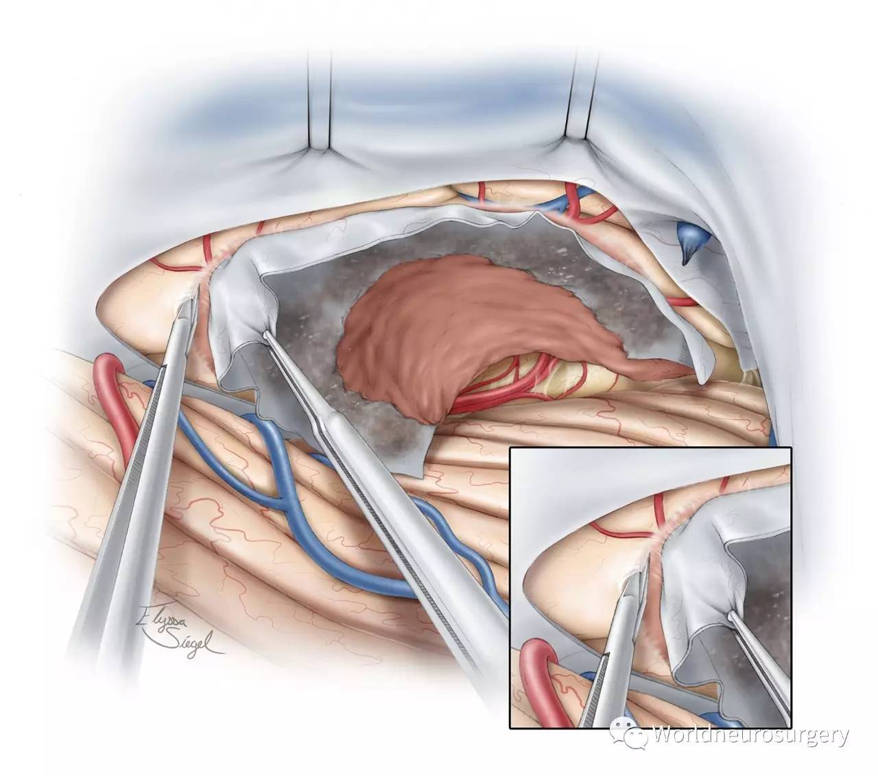 小腦幕腦膜瘤--the neurosurgical atlas系列