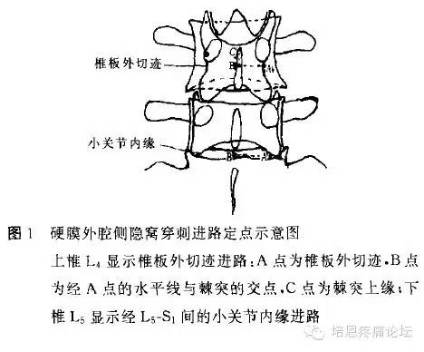 侧隐窝阻滞术进针点图片