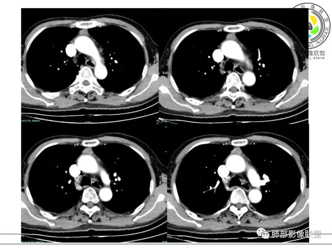 【每日晨读】胸腺瘤与胸腺癌之争