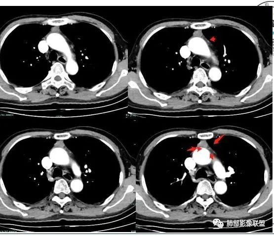 还是在残留的胸腺组织内.
