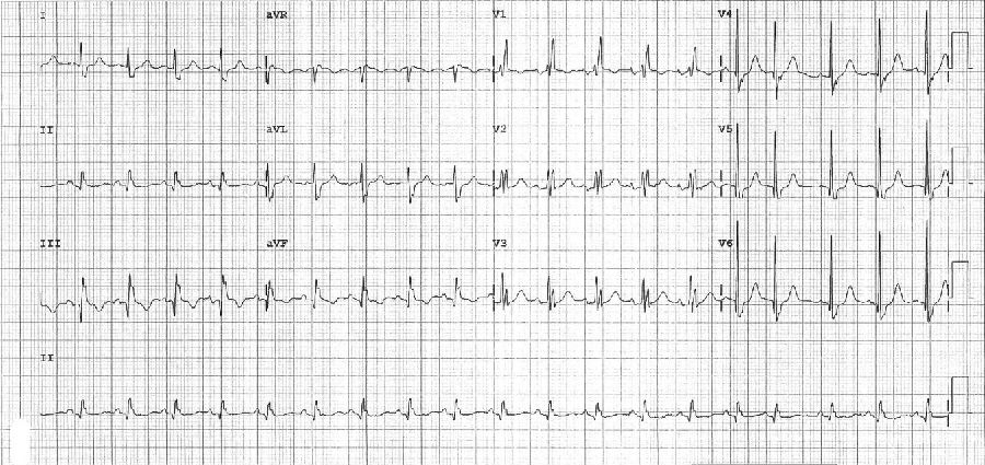 心电图老也搞不清的那些波啊——epsilon波