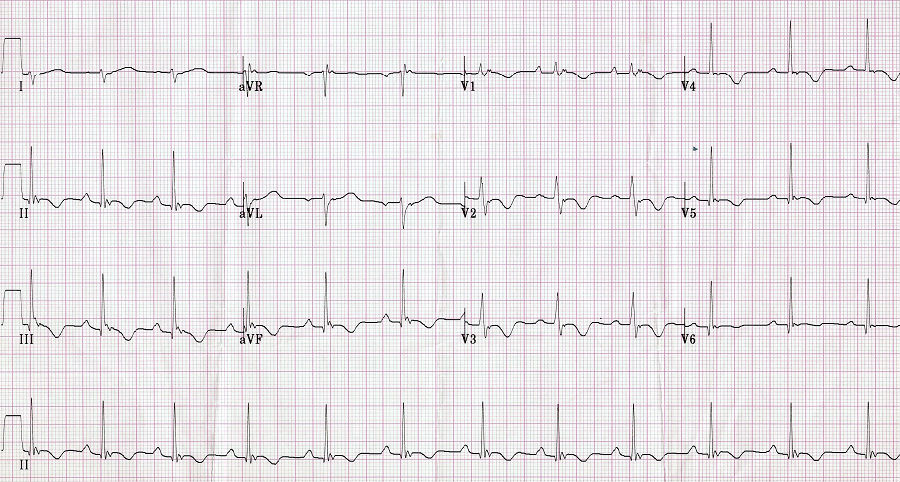 心电图老也搞不清的那些波啊——epsilon波