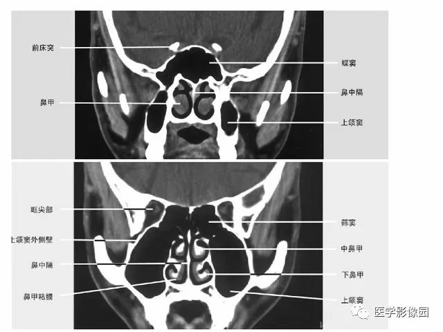 副鼻窦正常CT解剖图片