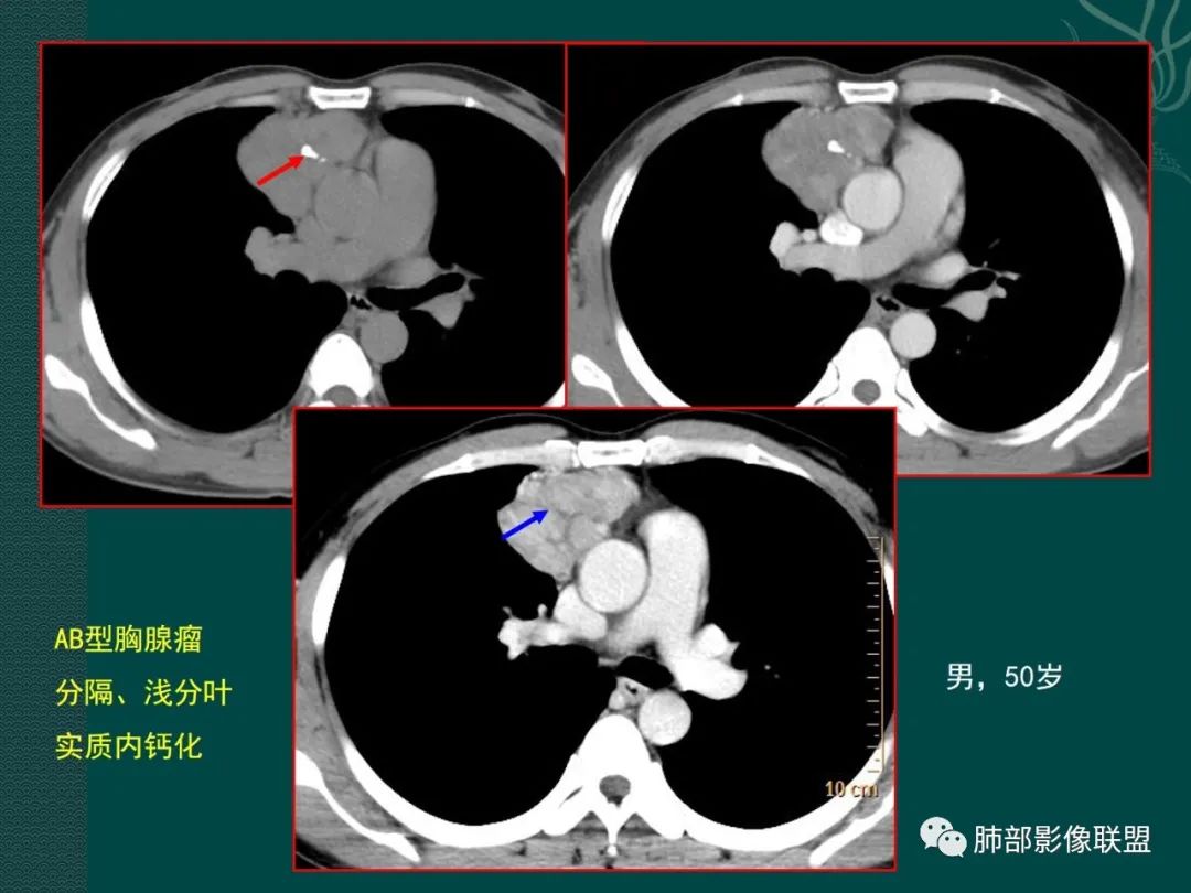 黄勇专题讲座胸腺淋巴瘤的影像诊断