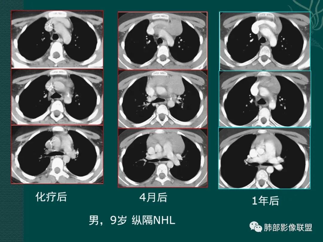 黃勇專題講座胸腺淋巴瘤的影像診斷