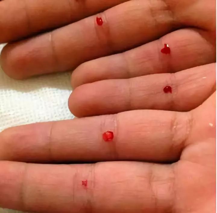 是不是全身都是滚烫的,回答是的,就是干烧的那种,我说"扎四缝"试试吧