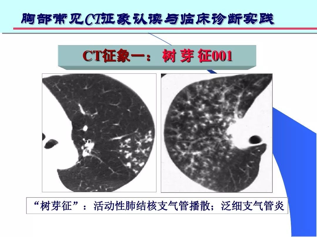 征象二:    轨道征与印戒征