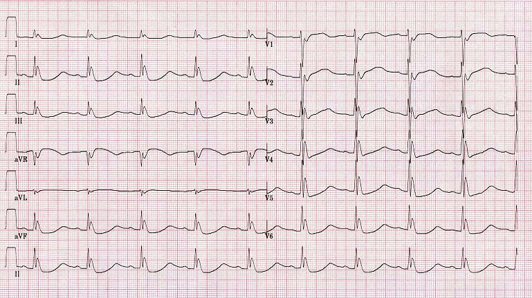 心电图老也搞不清的那些波啊j波osborn波