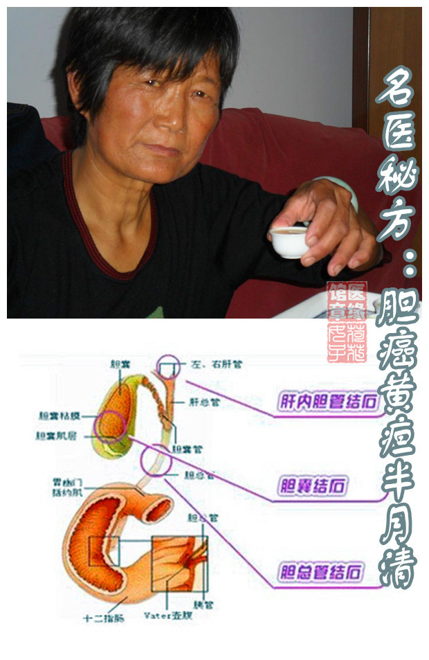 名医秘方胆癌黄疸半月清