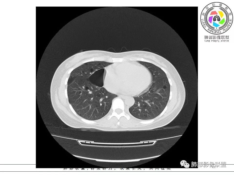 精彩讨论王开金江津中心医院呼吸科:青年女性,ct双肺多发囊性病变