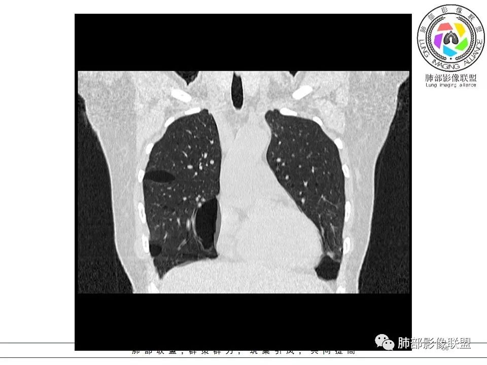 精彩讨论王开金江津中心医院呼吸科:青年女性,ct双肺多发囊性病变
